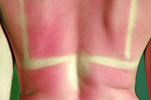 You are currently viewing When to See Your Doctor for Severe Sunburn